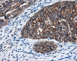 ELAVL1 / HUR Antibody - IHC of paraffin-embedded Adenocarcinoma of ovary tissue using anti-ELAVL1 mouse monoclonal antibody. (Dilution 1:50).