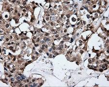 ELAVL1 / HUR Antibody - IHC of paraffin-embedded Adenocarcinoma of breast tissue using anti-ELAVL1 mouse monoclonal antibody. (Dilution 1:50).