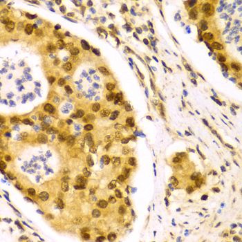ELAVL1 / HUR Antibody - Immunohistochemistry of paraffin-embedded human gastric cancer using ELAVL1 Antibodyat dilution of 1:100 (40x lens).
