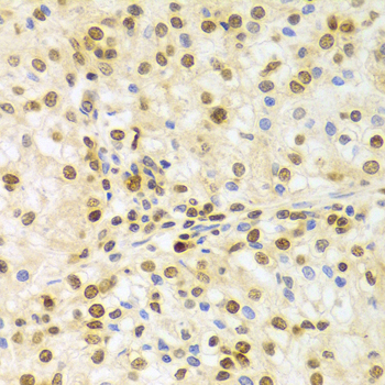 ELAVL1 / HUR Antibody - Immunohistochemistry of paraffin-embedded human kidney cancer using ELAVL1 Antibodyat dilution of 1:100 (40x lens).