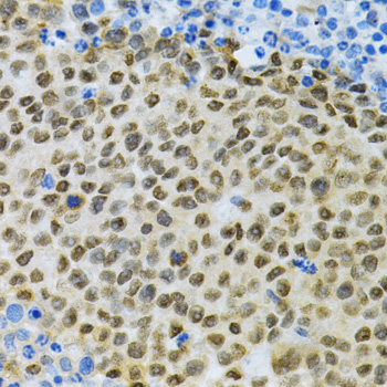 ELAVL1 / HUR Antibody - Immunohistochemistry of paraffin-embedded rat cancer using ELAVL1 Antibodyat dilution of 1:200 (40x lens).