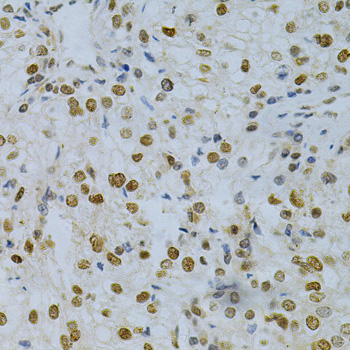ELAVL1 / HUR Antibody - Immunohistochemistry of paraffin-embedded human kidney cancer using ELAVL1 Antibodyat dilution of 1:200 (40x lens).