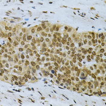 ELAVL1 / HUR Antibody - Immunohistochemistry of paraffin-embedded human esophageal cancer using ELAVL1 Antibodyat dilution of 1:200 (40x lens).