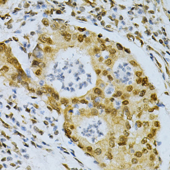 ELAVL1 / HUR Antibody - Immunohistochemistry of paraffin-embedded human gastric cancer using ELAVL1 Antibodyat dilution of 1:200 (40x lens).