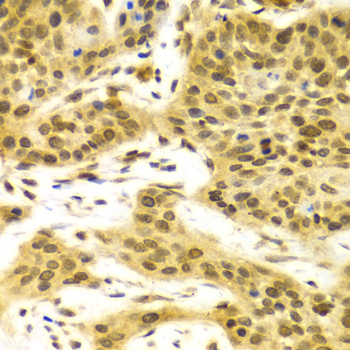 ELAVL1 / HUR Antibody - Immunohistochemistry of paraffin-embedded human esophageal cancer using ELAVL1 Antibodyat dilution of 1:100 (40x lens).