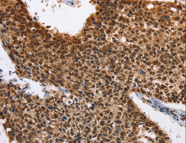 ELAVL1 / HUR Antibody - Immunohistochemistry of paraffin-embedded Human lung cancer using ELAVL1 Polyclonal Antibody at dilution of 1:40.