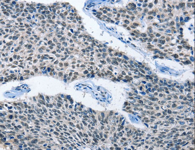 ELAVL1 / HUR Antibody - Immunohistochemistry of paraffin-embedded Human lung cancer using ELAVL1 Polyclonal Antibody at dilution of 1:50.