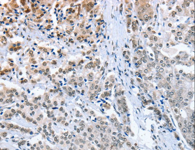 ELAVL1 / HUR Antibody - Immunohistochemistry of paraffin-embedded Human prostate cancer using ELAVL1 Polyclonal Antibody at dilution of 1:50.
