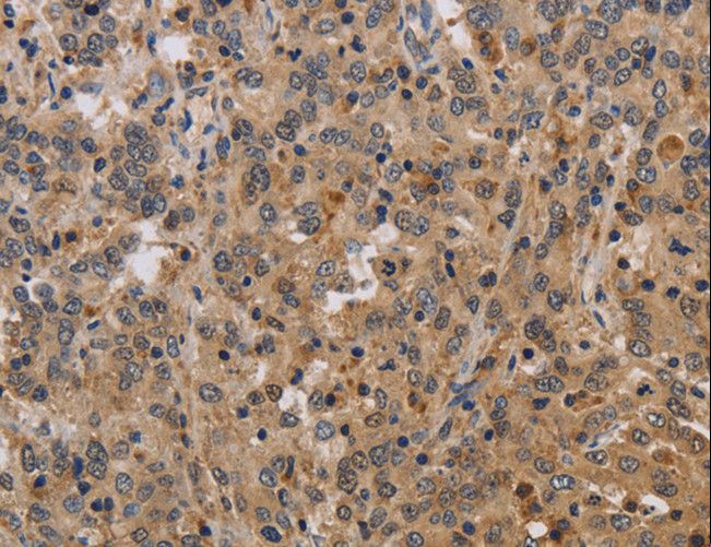 ELAVL2 / HUB Antibody - Immunohistochemistry of paraffin-embedded Human liver cancer using ELAVL2 Polyclonal Antibody at dilution of 1:40.