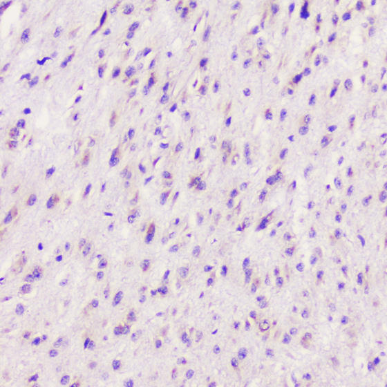 ELAVL2 / HUB Antibody - IHC analysis of ELAVL2 HuB using anti-ELAVL2 HuB antibody. ELAVL2 HuB was detected in paraffin-embedded section of human glioma tissue. Heat mediated antigen retrieval was performed in citrate buffer (pH6, epitope retrieval solution) for 20 mins. The tissue section was blocked with 10% goat serum. The tissue section was then incubated with 1µg/ml rabbit anti-ELAVL2 HuB Antibody overnight at 4°C. Biotinylated goat anti-rabbit IgG was used as secondary antibody and incubated for 30 minutes at 37°C. The tissue section was developed using Strepavidin-Biotin-Complex (SABC) with DAB as the chromogen.