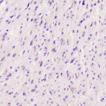 ELAVL2 / HUB Antibody - IHC staining of FFPE human glioma with ELAVL2 antibody at 1ug/ml. HIER: boil tissue sections in pH6, 10mM citrate buffer, for 10-20 min followed by cooling at RT for 20 min.