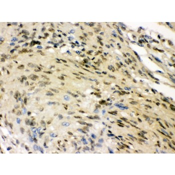 ELAVL4 / HuD Antibody - ELAVL4 antibody IHC-paraffin. IHC(P): Human Meningioma Tissue.