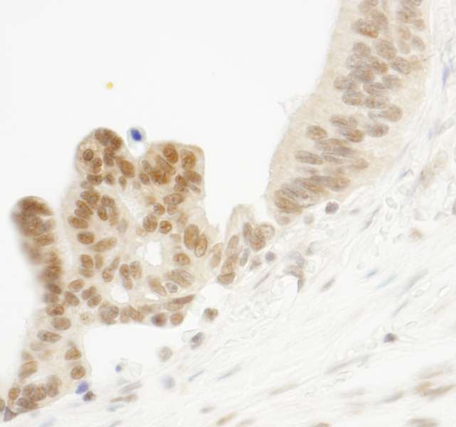 ELF1 Antibody - Detection of Human ELF1 Immunohistochemistry. Sample: FFPE section of human ovarian carcinoma. Antibody: Affinity purified rabbit anti-ELF1 used at a dilution of 1:250.