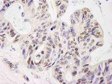 ELF1 Antibody - Detection of Human ELF1 by Immunohistochemistry. Sample: FFPE section of human ovarian carcinoma. Antibody: Affinity purified rabbit anti-ELF1 used at a dilution of1:200 (1Detection: DAB.