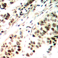 ELF1 Antibody - Immunohistochemical analysis of ELF1 staining in human ovarian cancer formalin fixed paraffin embedded tissue section. The section was pre-treated using heat mediated antigen retrieval with sodium citrate buffer (pH 6.0). The section was then incubated with the antibody at room temperature and detected using an HRP conjugated compact polymer system. DAB was used as the chromogen. The section was then counterstained with hematoxylin and mounted with DPX.