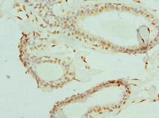 ELF1 Antibody - Immunohistochemistry of paraffin-embedded human breast cancer at dilution 1:100