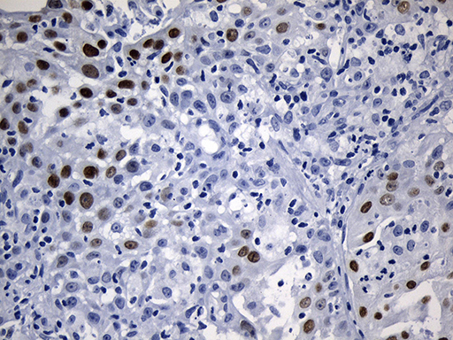 ELF3 / ESE1 Antibody - Immunohistochemical staining of paraffin-embedded Carcinoma of Human bladder tissue using anti-ELF3 mouse monoclonal antibody. (Heat-induced epitope retrieval by 1mM EDTA in 10mM Tris buffer. (pH8.5) at 120°C for 3 min. (1:500)