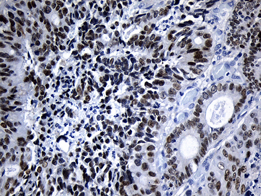 ELF3 / ESE1 Antibody - Immunohistochemical staining of paraffin-embedded Adenocarcinoma of Human colon tissue using anti-ELF3 mouse monoclonal antibody. (Heat-induced epitope retrieval by 1mM EDTA in 10mM Tris buffer. (pH8.5) at 120°C for 3 min. (1:500)