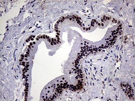 ELF3 / ESE1 Antibody - Immunohistochemical staining of paraffin-embedded Carcinoma of Human pancreas tissue using anti-ELF3 mouse monoclonal antibody. (Heat-induced epitope retrieval by 1mM EDTA in 10mM Tris buffer. (pH8.5) at 120°C for 3 min. (1:250)