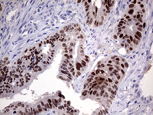 ELF3 / ESE1 Antibody - Immunohistochemical staining of paraffin-embedded Adenocarcinoma of Human colon tissue using anti-ELF3 mouse monoclonal antibody. (Heat-induced epitope retrieval by 1mM EDTA in 10mM Tris buffer. (pH8.5) at 120°C for 3 min. (1:250)