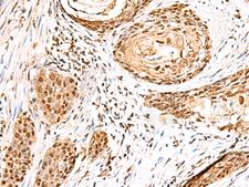 ELF3 / ESE1 Antibody - Immunohistochemistry of paraffin-embedded Human esophagus cancer tissue  using ELF3 Polyclonal Antibody at dilution of 1:95(×200)