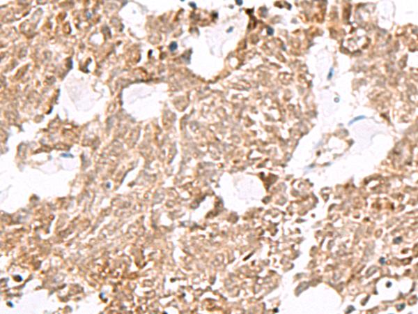 ELF3 / ESE1 Antibody - Immunohistochemistry of paraffin-embedded Human lung cancer tissue  using ELF3 Polyclonal Antibody at dilution of 1:60(×200)