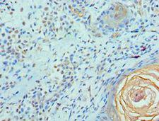 ELF4 / MEF Antibody - Immunohistochemistry of paraffin-embedded human breast cancer using antibody at 1:100 dilution.
