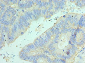 ELF4 / MEF Antibody - Immunohistochemistry of paraffin-embedded human colon cancer using ELF4 Antibody at dilution of 1:100