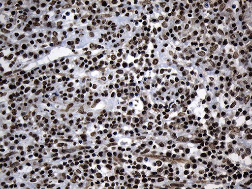 ELF4 / MEF Antibody - Immunohistochemical staining of paraffin-embedded Carcinoma of Human bladder tissue using anti-ELF4 mouse monoclonal antibody. (Heat-induced epitope retrieval by 1mM EDTA in 10mM Tris buffer. (pH8.5) at 120°C for 3 min. (1:500)