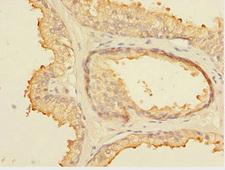 ELF5 Antibody - Immunohistochemistry of paraffin-embedded human prostata cancer at dilution 1:100