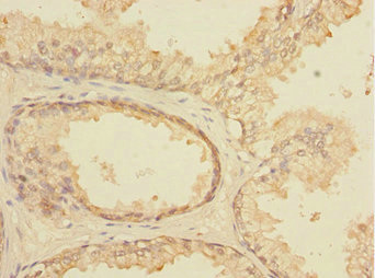ELF5 Antibody - Immunohistochemistry of paraffin-embedded human prostata cancer at dilution 1:100