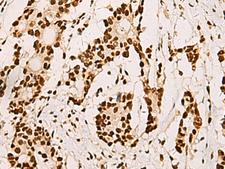 ELF5 Antibody - Immunohistochemistry of paraffin-embedded Human colorectal cancer tissue  using ELF5 Polyclonal Antibody at dilution of 1:70(×200)