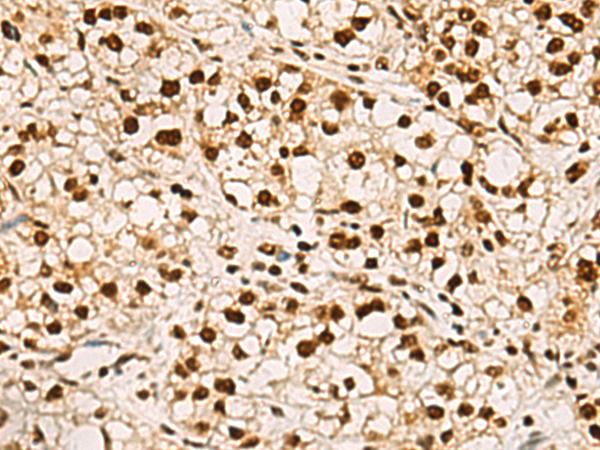 ELF5 Antibody - Immunohistochemistry of paraffin-embedded Human liver cancer tissue  using ELF5 Polyclonal Antibody at dilution of 1:75(×200)