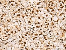 ELF5 Antibody - Immunohistochemistry of paraffin-embedded Human liver cancer tissue  using ELF5 Polyclonal Antibody at dilution of 1:75(×200)