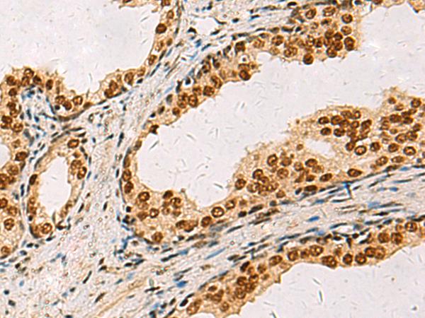 ELF5 Antibody - Immunohistochemistry of paraffin-embedded Human prost ate cancer tissue  using ELF5 Polyclonal Antibody at dilution of 1:75(×200)