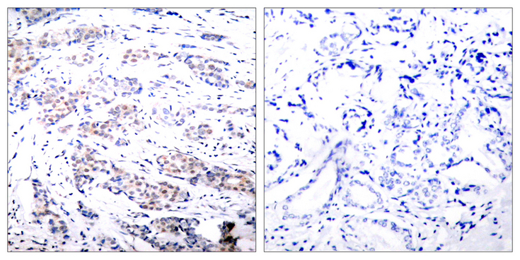ELK1 Antibody - Immunohistochemistry analysis of paraffin-embedded human breast carcinoma tissue, using Elk1 Antibody. The picture on the right is blocked with the synthesized peptide.