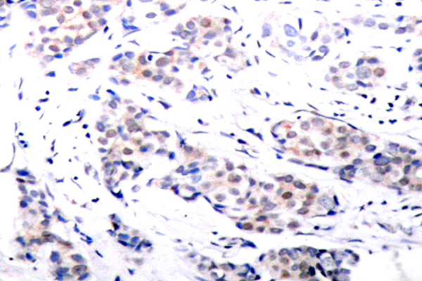 ELK1 Antibody - IHC of Elk1 (H377) pAb in paraffin-embedded human breast carcinoma tissue.
