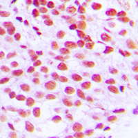 ELK1 Antibody - Immunohistochemical analysis of ELK1 staining in human breast cancer formalin fixed paraffin embedded tissue section. The section was pre-treated using heat mediated antigen retrieval with sodium citrate buffer (pH 6.0). The section was then incubated with the antibody at room temperature and detected using an HRP conjugated compact polymer system. DAB was used as the chromogen. The section was then counterstained with hematoxylin and mounted with DPX.
