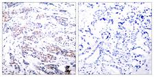 ELK1 Antibody - Immunohistochemical analysis of paraffin- embedded breast carcinoma. Left: Using Elk-1 (Ab-383) Antibody; Right: Using the same antibody preincubated with synthesized peptide.