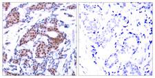 ELK1 Antibody - Immunohistochemical analysis of paraffin-embedded breast carcinoma. Left: Using Elk-1 (Phospho- Ser383) Antibody; Right: The same antibody preincubated with synthesized phosphopeptide.