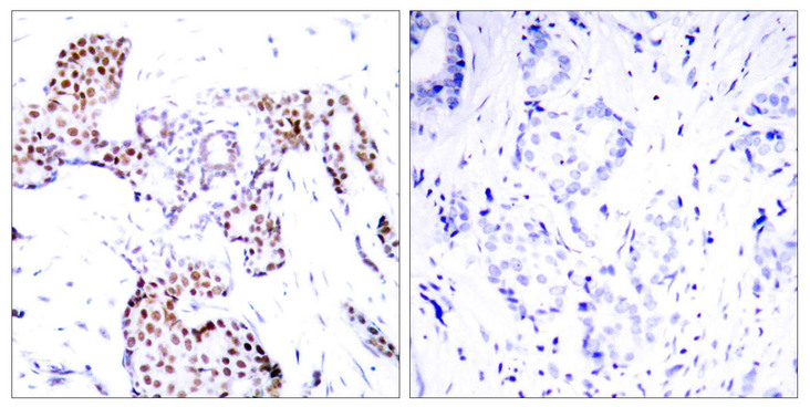 ELK1 Antibody - Immunohistochemistry analysis of paraffin-embedded human breast carcinoma, using Elk1 (Phospho-Ser389) Antibody. The picture on the right is blocked with the phospho peptide.