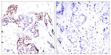 ELK1 Antibody - Immunohistochemistry analysis of paraffin-embedded human breast carcinoma, using Elk1 (Phospho-Ser389) Antibody. The picture on the right is blocked with the phospho peptide.