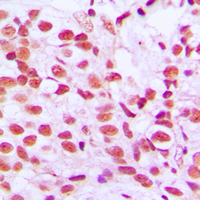 ELK1 Antibody - Immunohistochemical analysis of ELK1 (pS389) staining in human breast cancer formalin fixed paraffin embedded tissue section. The section was pre-treated using heat mediated antigen retrieval with sodium citrate buffer (pH 6.0). The section was then incubated with the antibody at room temperature and detected using an HRP conjugated compact polymer system. DAB was used as the chromogen. The section was then counterstained with hematoxylin and mounted with DPX.