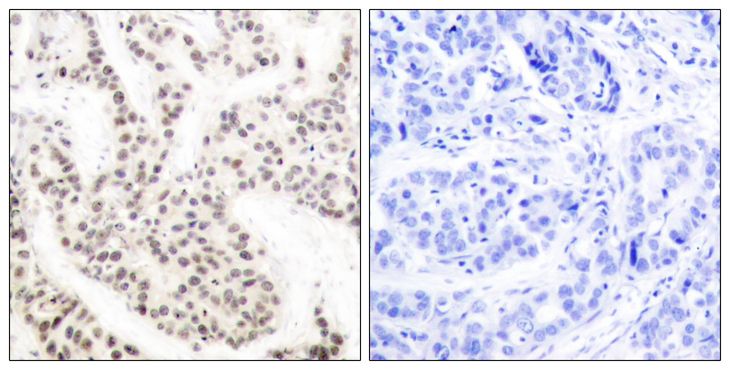 ELK1 Antibody - Immunohistochemistry analysis of paraffin-embedded human breast carcinoma, using Elk1 (Phospho-Thr417) Antibody. The picture on the right is blocked with the phospho peptide.