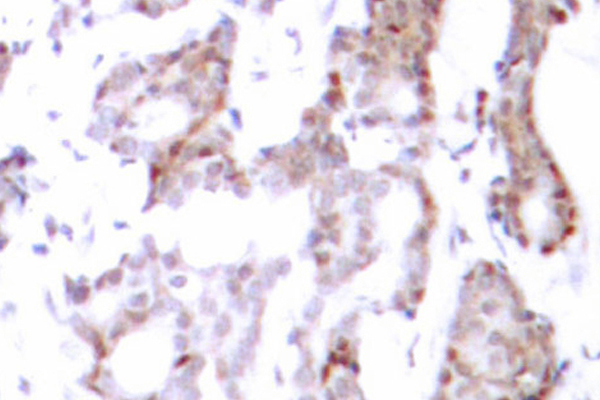 ELK1 Antibody - IHC of Elk1 (S383) pAb in paraffin-embedded human breast carcinoma tissue.