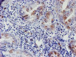 ELK3 / NET Antibody - IHC of paraffin-embedded Adenocarcinoma of Human endometrium tissue using anti-ELK3 mouse monoclonal antibody. (Heat-induced epitope retrieval by 10mM citric buffer, pH6.0, 100C for 10min).