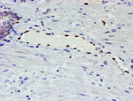 ELK3 / NET Antibody - IHC of paraffin-embedded Carcinoma of Human prostate tissue using anti-ELK3 mouse monoclonal antibody. (Heat-induced epitope retrieval by 10mM citric buffer, pH6.0, 100C for 10min).