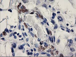 ELK3 / NET Antibody - IHC of paraffin-embedded Carcinoma of Human bladder tissue using anti-ELK3 mouse monoclonal antibody.