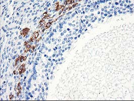 ELK3 / NET Antibody - IHC of paraffin-embedded Adenocarcinoma of Human ovary tissue using anti-ELK3 mouse monoclonal antibody.