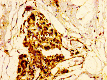 ELK3 / NET Antibody - Immunohistochemistry image at a dilution of 1:500 and staining in paraffin-embedded human breast cancer performed on a Leica BondTM system. After dewaxing and hydration, antigen retrieval was mediated by high pressure in a citrate buffer (pH 6.0) . Section was blocked with 10% normal goat serum 30min at RT. Then primary antibody (1% BSA) was incubated at 4 °C overnight. The primary is detected by a biotinylated secondary antibody and visualized using an HRP conjugated SP system.